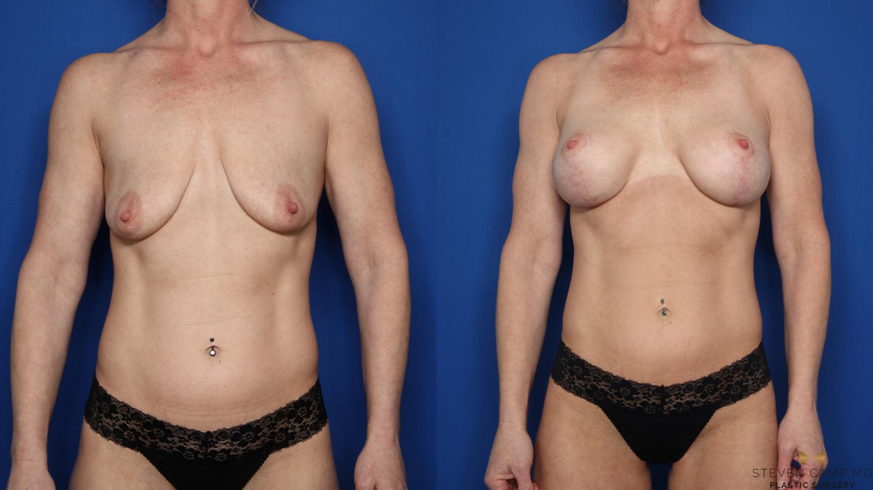Before & After Breast Lift (Breast Mastopexy with Implants) Case 597 Front View in Fort Worth & Arlington, Texas