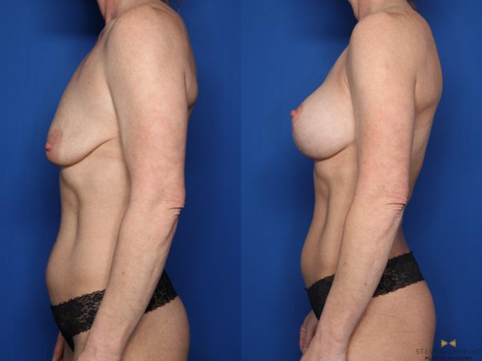 Before & After Breast Lift (Breast Mastopexy with Implants) Case 597 Left Side View in Fort Worth & Arlington, Texas