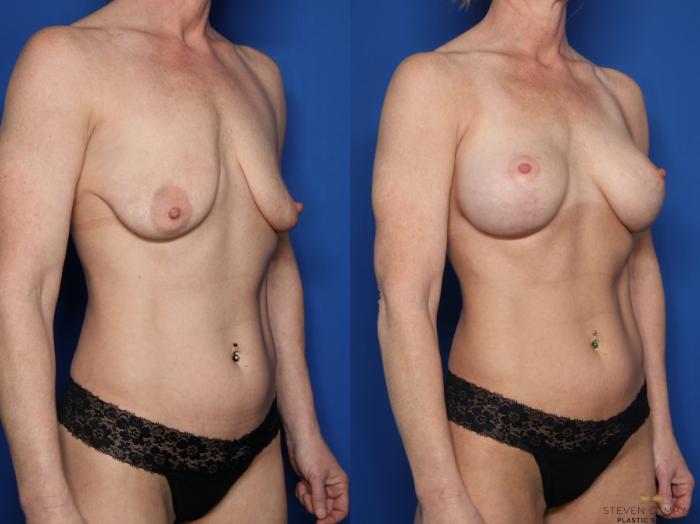 Before & After Breast Lift (Breast Mastopexy with Implants) Case 597 Right Oblique View in Fort Worth & Arlington, Texas