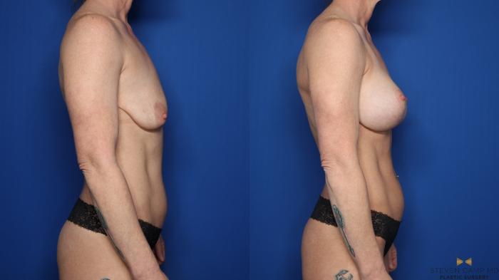 Before & After Breast Lift (Breast Mastopexy with Implants) Case 597 Right Side View in Fort Worth & Arlington, Texas