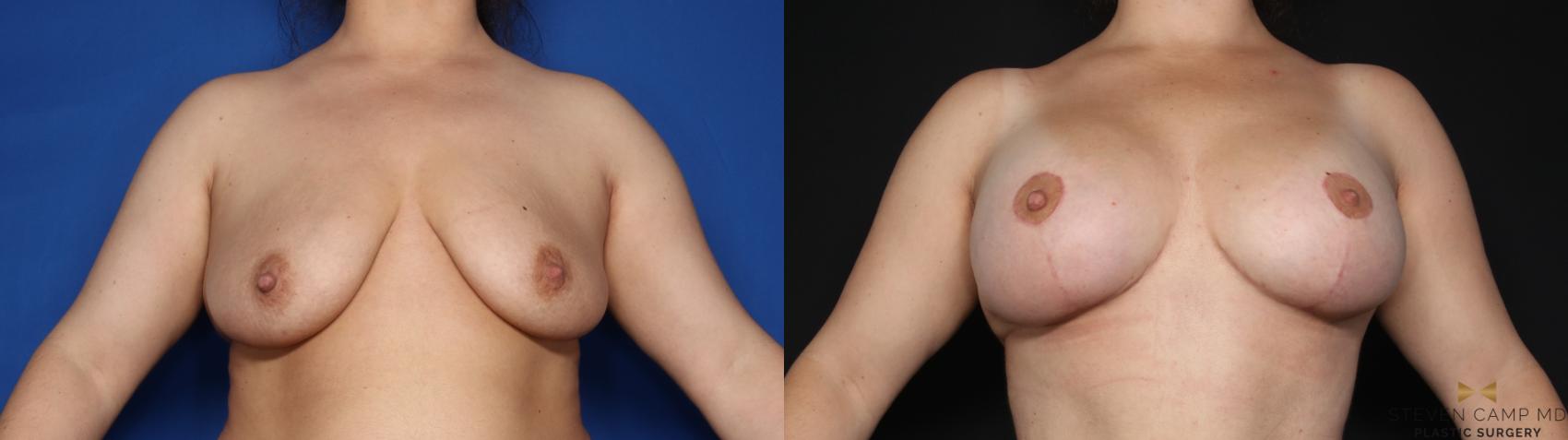 Before & After Breast Lift (Breast Mastopexy with Implants) Case 632 Front View in Fort Worth & Arlington, Texas