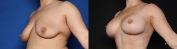 Before & After Breast Lift (Breast Mastopexy with Implants) Case 632 Left Oblique View in Fort Worth & Arlington, Texas