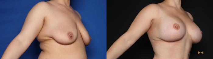 Before & After Breast Lift (Breast Mastopexy with Implants) Case 632 Right Oblique View in Fort Worth & Arlington, Texas