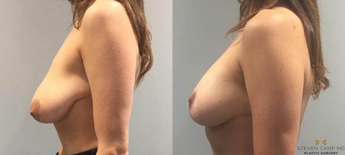 Before & After Breast Lift (Breast Mastopexy with Implants) Case 93 View #1 View in Fort Worth & Arlington, Texas