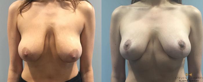 Before & After Breast Lift (Breast Mastopexy with Implants) Case 93 View #2 View in Fort Worth & Arlington, Texas