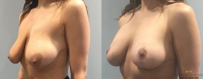 Before & After Breast Lift (Breast Mastopexy with Implants) Case 93 View #3 View in Fort Worth & Arlington, Texas