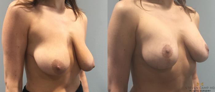Before & After Breast Lift (Breast Mastopexy with Implants) Case 93 View #4 View in Fort Worth & Arlington, Texas