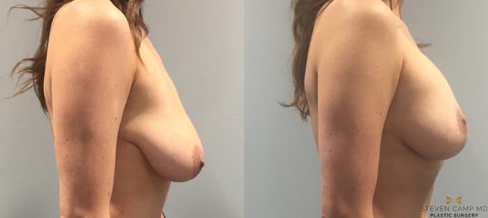 Before & After Breast Lift (Breast Mastopexy with Implants) Case 93 View #5 View in Fort Worth & Arlington, Texas