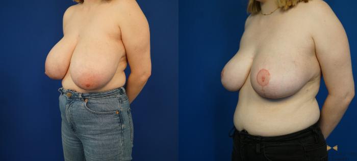 Before & After Breast Reduction Case 171 View #2 View in Fort Worth & Arlington, Texas