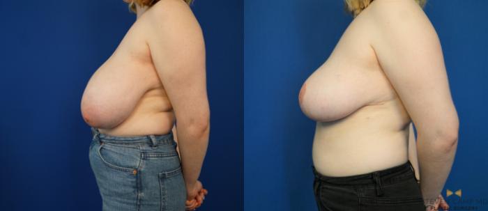Before & After Breast Reduction Case 171 View #3 View in Fort Worth & Arlington, Texas