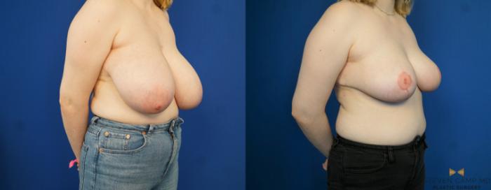 Before & After Breast Reduction Case 171 View #4 View in Fort Worth & Arlington, Texas
