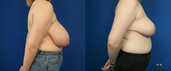 Before & After Breast Reduction Case 171 View #5 View in Fort Worth & Arlington, Texas