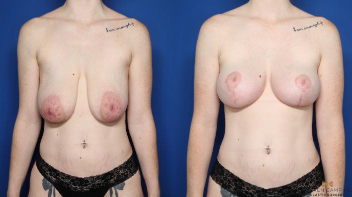 Before & After Breast Reduction Case 555 Front View in Fort Worth & Arlington, Texas