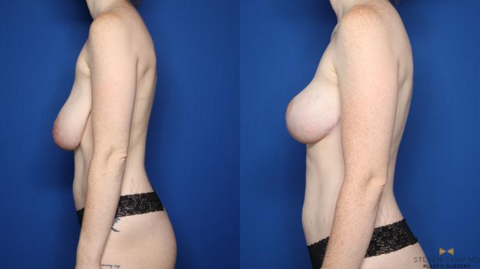 Before & After Breast Reduction Case 555 Left Side View in Fort Worth & Arlington, Texas