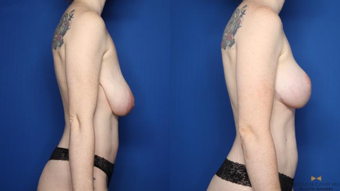 Before & After Breast Reduction Case 555 Right Side View in Fort Worth & Arlington, Texas
