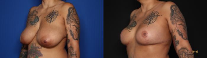 Before & After Breast Reduction Case 627 Left Oblique View in Fort Worth & Arlington, Texas
