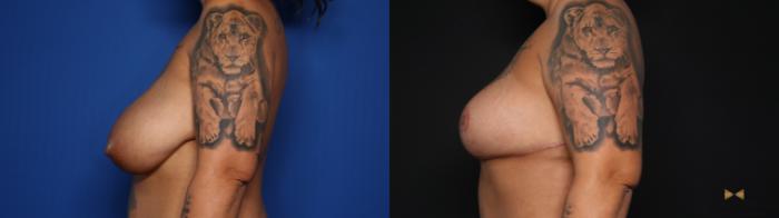 Before & After Breast Reduction Case 627 Left Side View in Fort Worth & Arlington, Texas