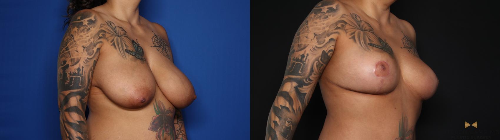 Before & After Breast Reduction Case 627 Right Oblique View in Fort Worth & Arlington, Texas