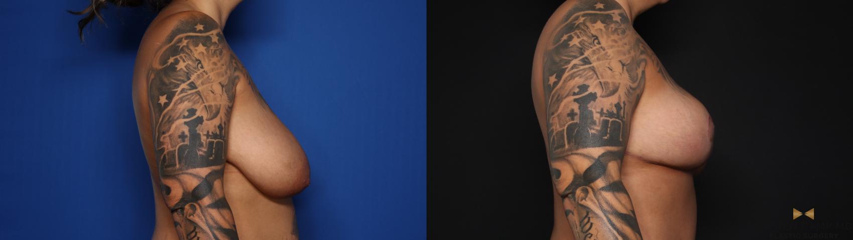 Before & After Breast Reduction Case 627 Right Side View in Fort Worth & Arlington, Texas