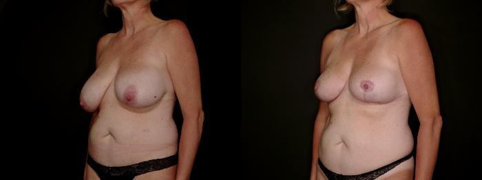 Before & After Breast Reduction Case 792 Left Oblique View in Fort Worth & Arlington, Texas