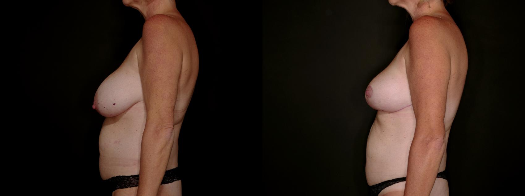 Before & After Breast Reduction Case 792 Left Side View in Fort Worth & Arlington, Texas