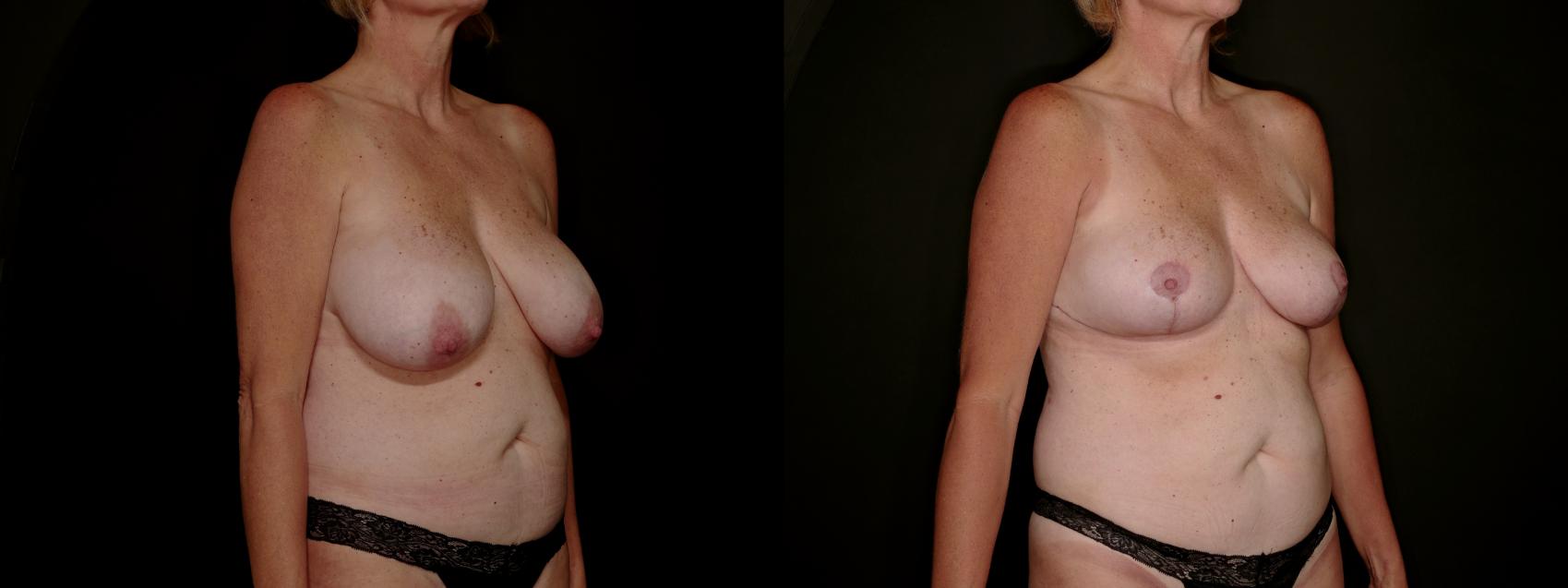 Before & After Breast Reduction Case 792 Right Oblique View in Fort Worth & Arlington, Texas