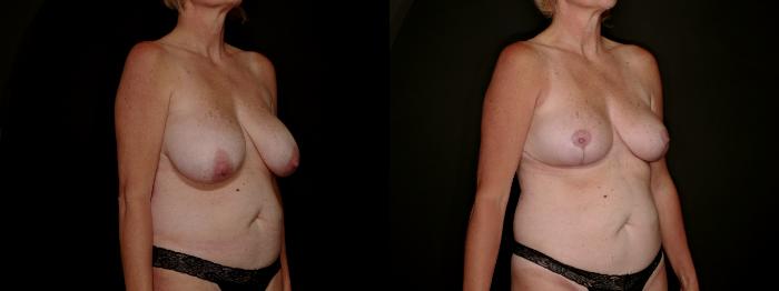 Before & After Breast Reduction Case 792 Right Oblique View in Fort Worth & Arlington, Texas