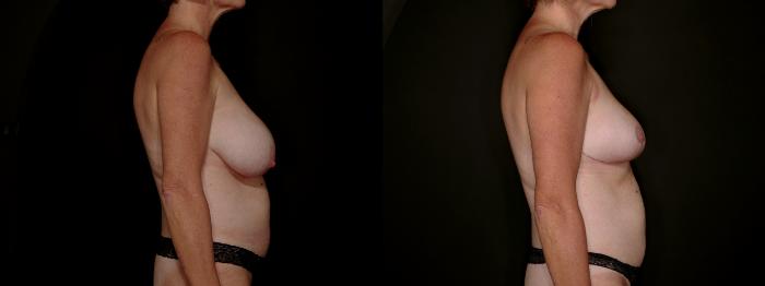 Before & After Breast Reduction Case 792 Right Side View in Fort Worth & Arlington, Texas