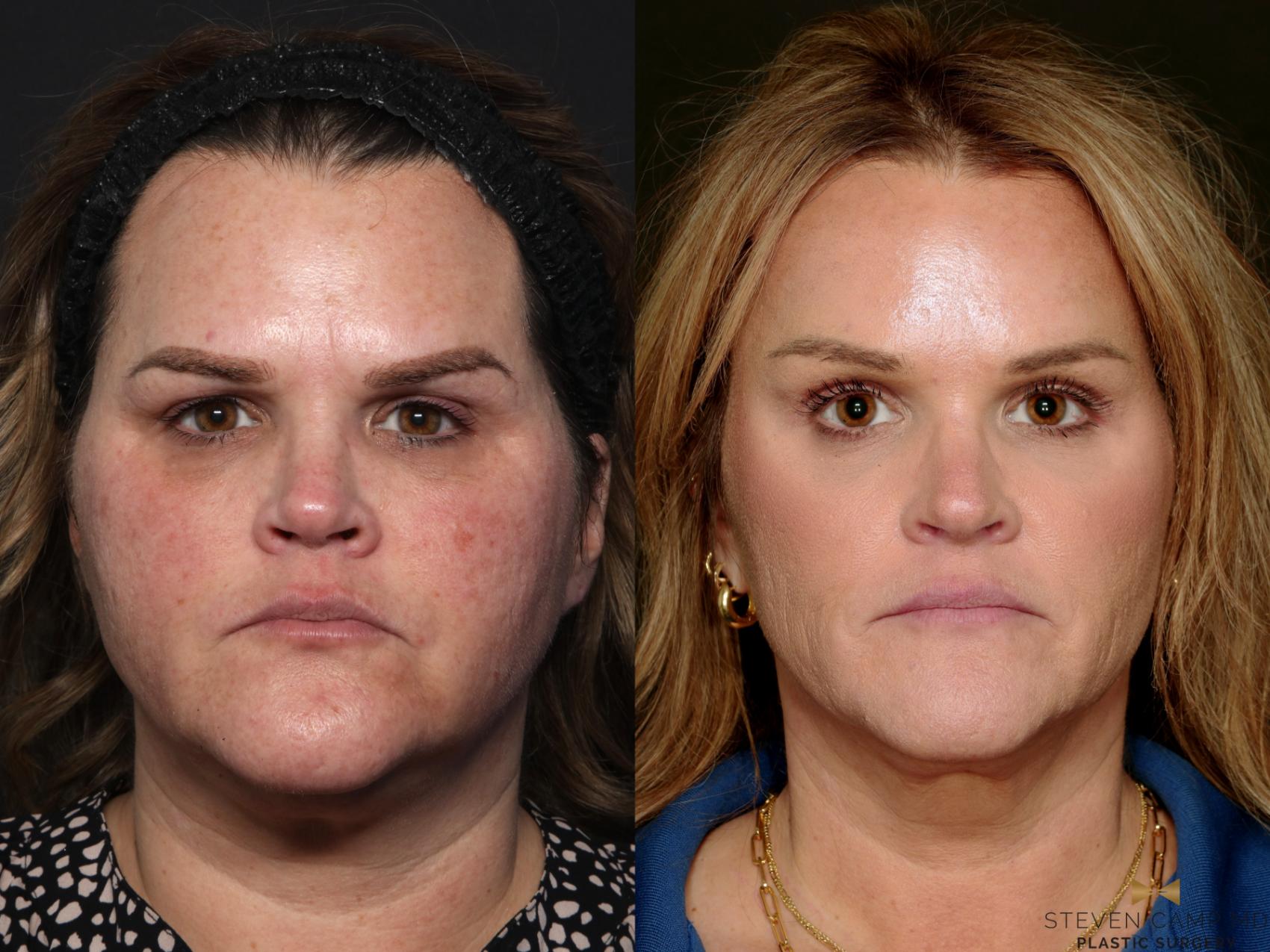 Before & After Brow Lift Case 713 Front View in Fort Worth & Arlington, Texas