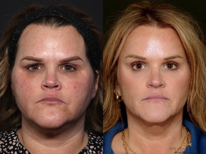 Before & After Brow Lift Case 713 Front View in Fort Worth & Arlington, Texas
