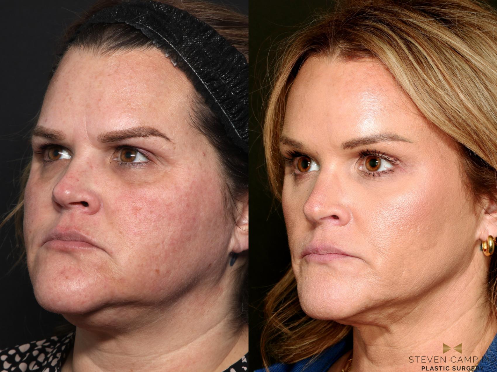 Before & After Brow Lift Case 713 Left Oblique View in Fort Worth & Arlington, Texas