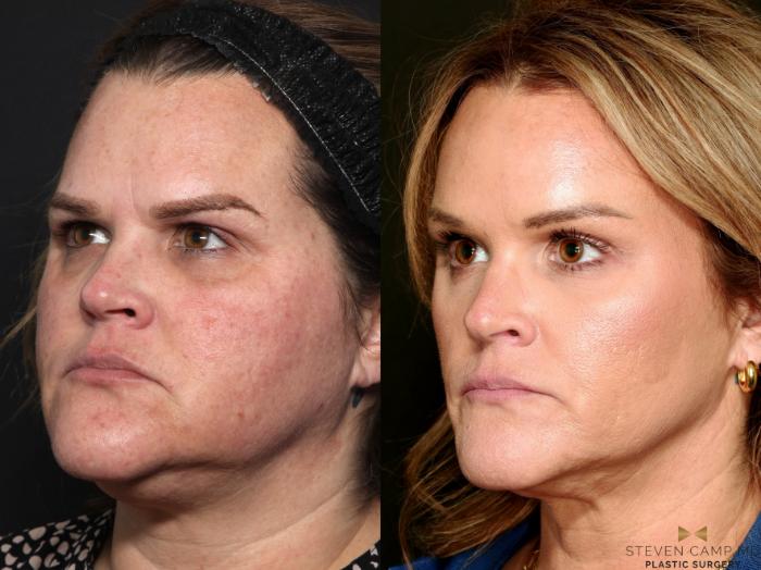 Before & After Brow Lift Case 713 Left Oblique View in Fort Worth & Arlington, Texas