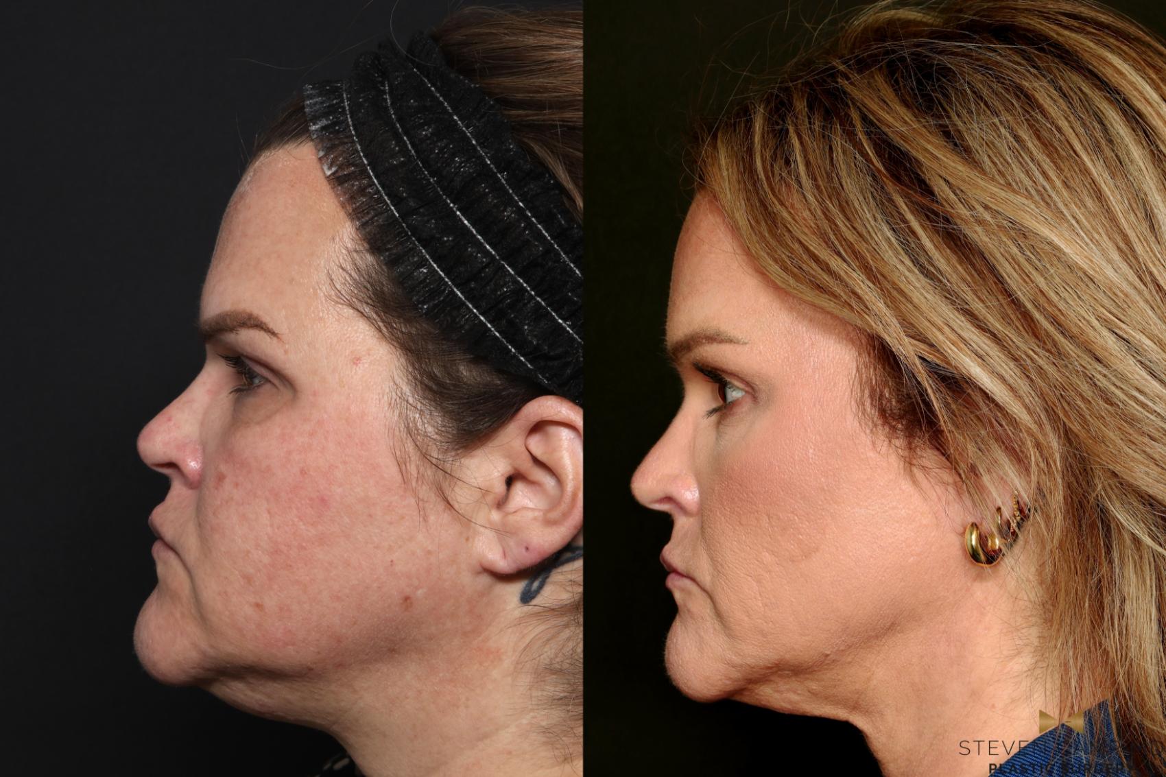 Before & After Brow Lift Case 713 Left Side View in Fort Worth & Arlington, Texas