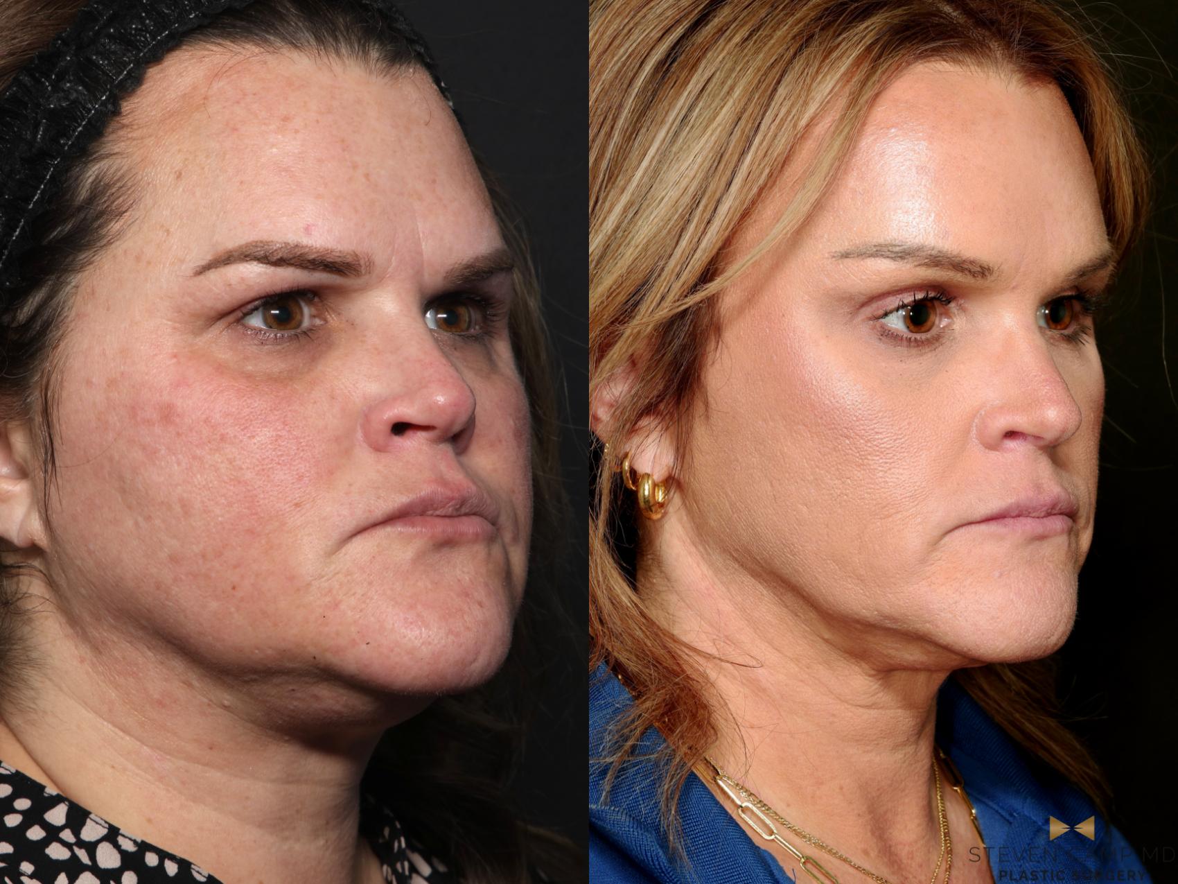 Before & After Brow Lift Case 713 Right Oblique View in Fort Worth & Arlington, Texas