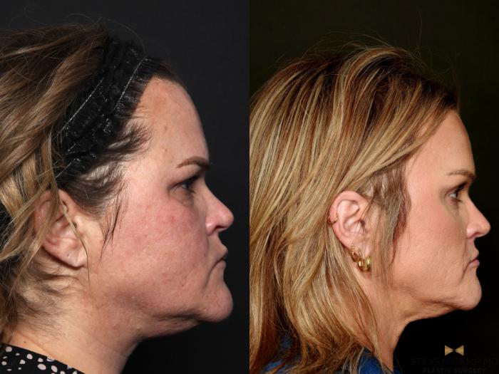 Before & After Brow Lift Case 713 Right Side View in Fort Worth & Arlington, Texas