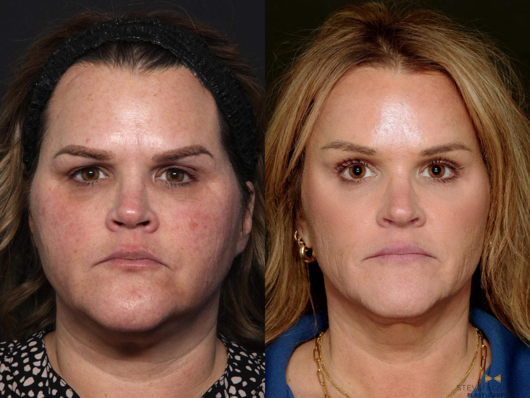 Before & After BOTOX Case 713 Front View in Fort Worth & Arlington, Texas