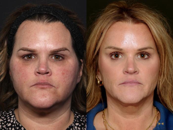 Before & After BOTOX Case 713 Front View in Fort Worth & Arlington, Texas
