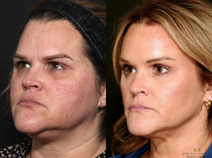 Before & After BOTOX Case 713 Left Oblique View in Fort Worth & Arlington, Texas