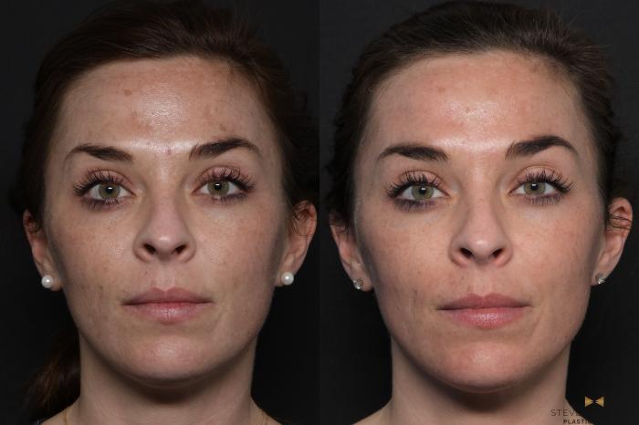 Before & After Chemical Peel Case 600 Front View in Fort Worth & Arlington, Texas