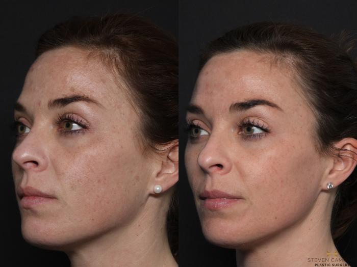 Before & After Chemical Peel Case 600 Left Oblique View in Fort Worth & Arlington, Texas