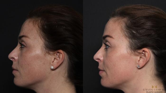 Before & After Chemical Peel Case 600 Left Side View in Fort Worth & Arlington, Texas
