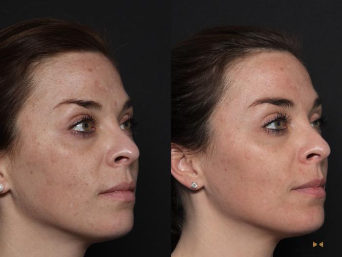 Before & After Chemical Peel Case 600 Right Oblique View in Fort Worth & Arlington, Texas