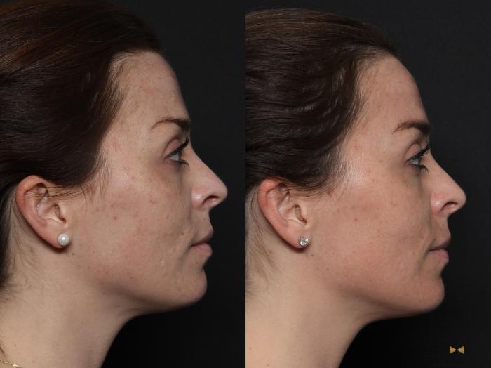 Before & After Chemical Peel Case 600 Right Side View in Fort Worth & Arlington, Texas