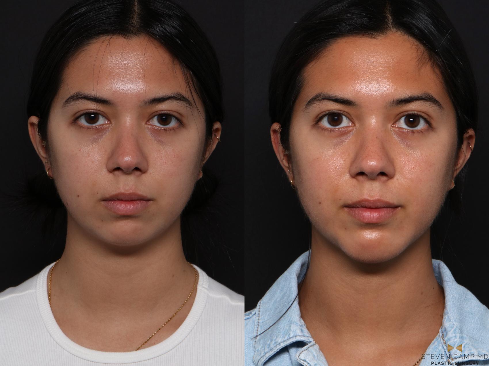 Before & After Chin Implant Case 704 Front View in Fort Worth & Arlington, Texas