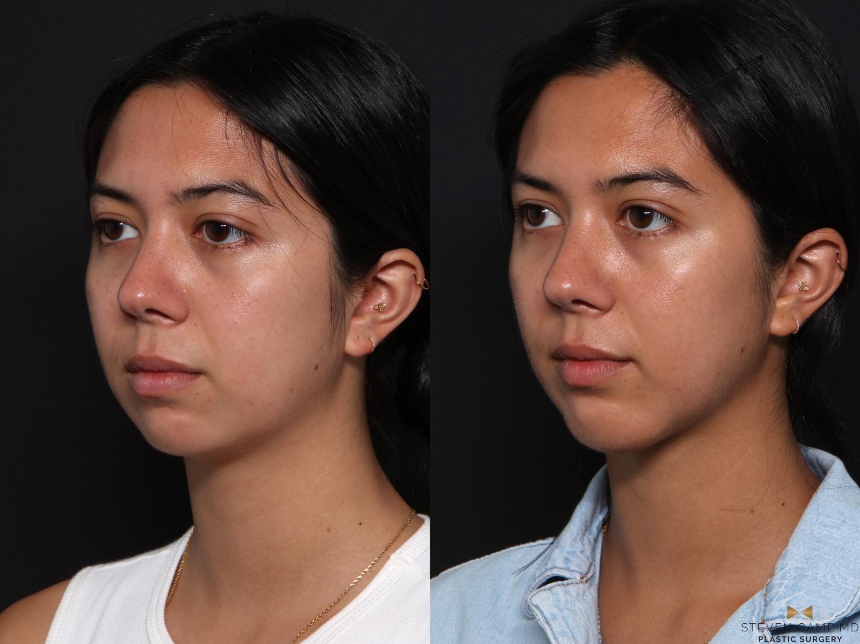 Before & After Chin Implant Case 704 Left Oblique View in Fort Worth & Arlington, Texas