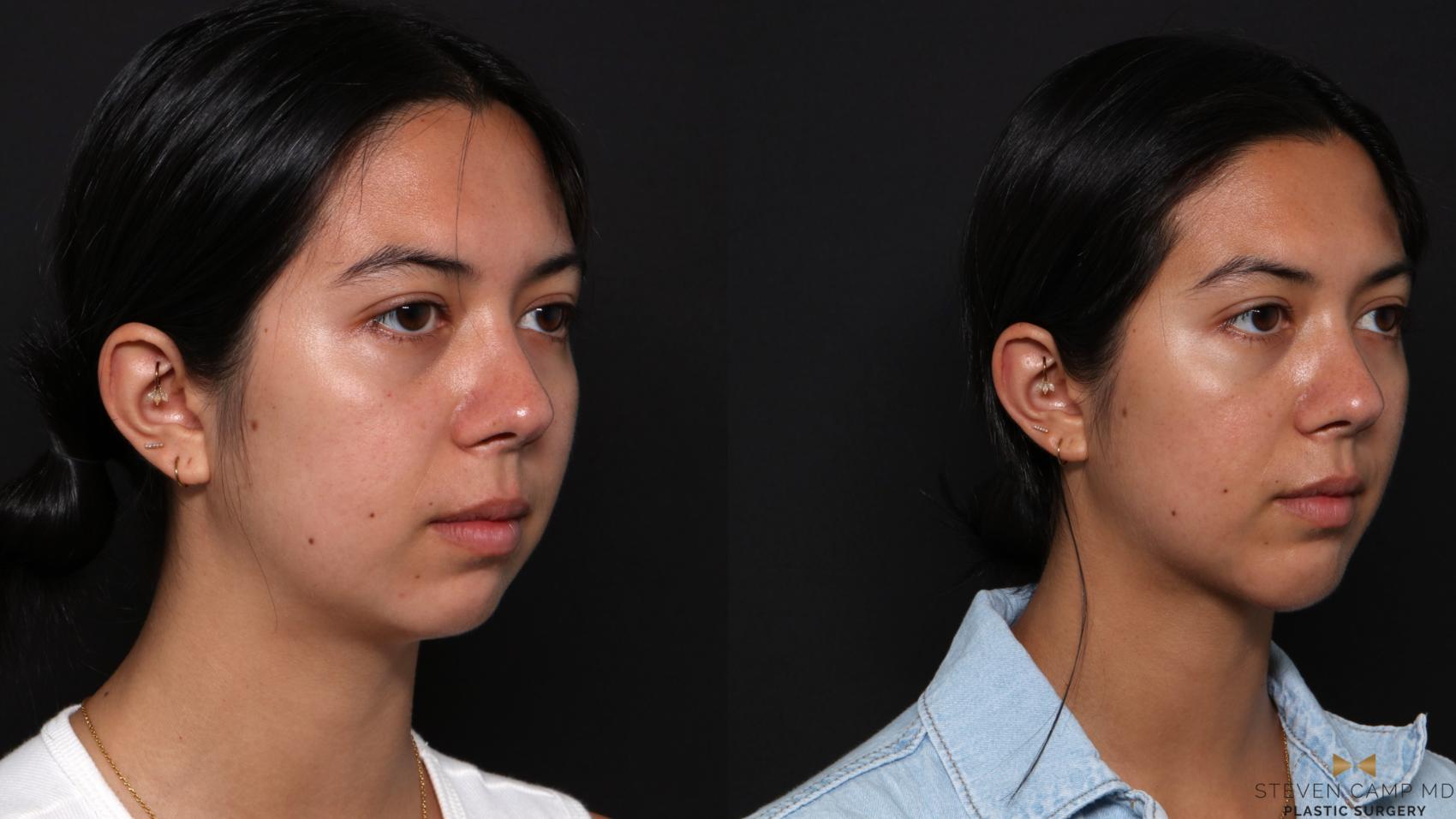 Before & After Chin Implant Case 704 Right Oblique View in Fort Worth & Arlington, Texas