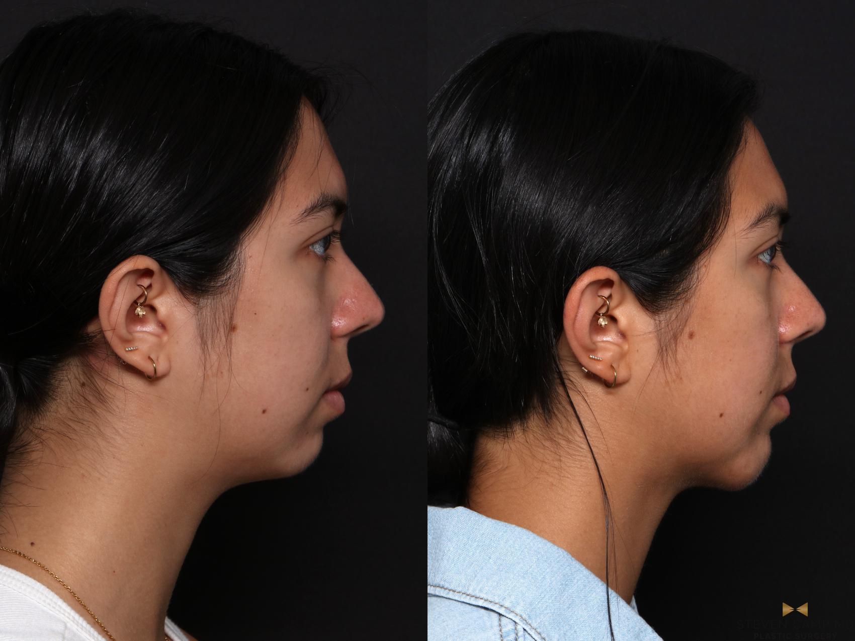 Before & After Chin Implant Case 704 Right Side View in Fort Worth & Arlington, Texas