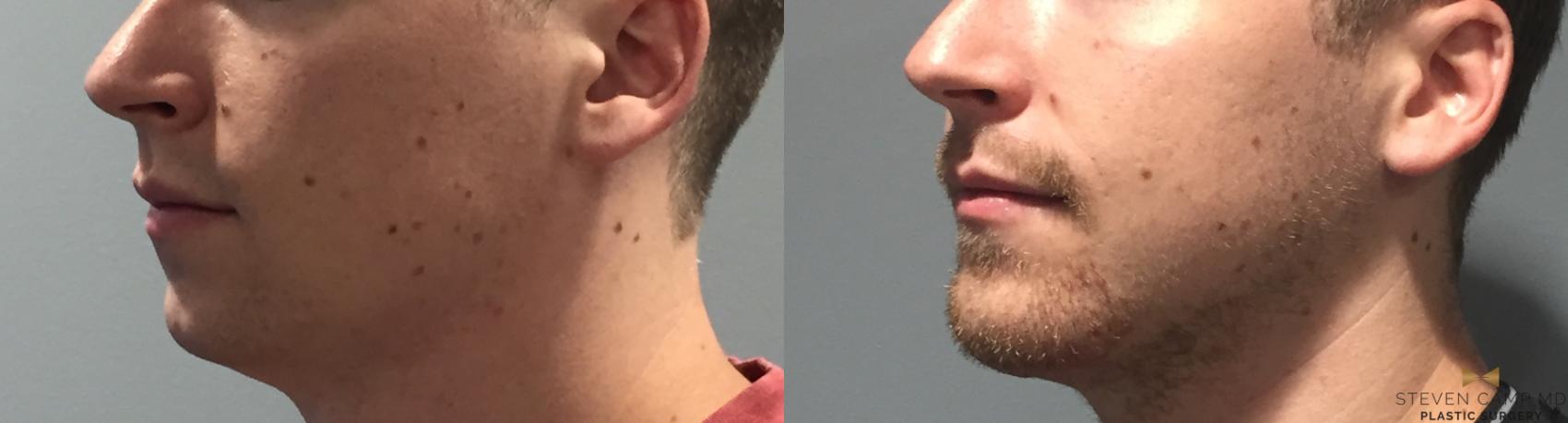 Before & After Chin Implant Case 91 View #1 View in Fort Worth & Arlington, Texas