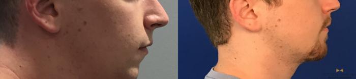 Before & After Chin Implant Case 91 View #10 View in Fort Worth & Arlington, Texas
