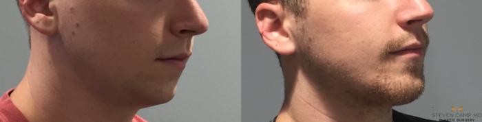 Before & After Chin Implant Case 91 View #2 View in Fort Worth & Arlington, Texas